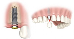 karsiyaka izmir implant