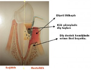 karsiyaka_dis_saglikli_dis_eti_diş eti hastalıkları